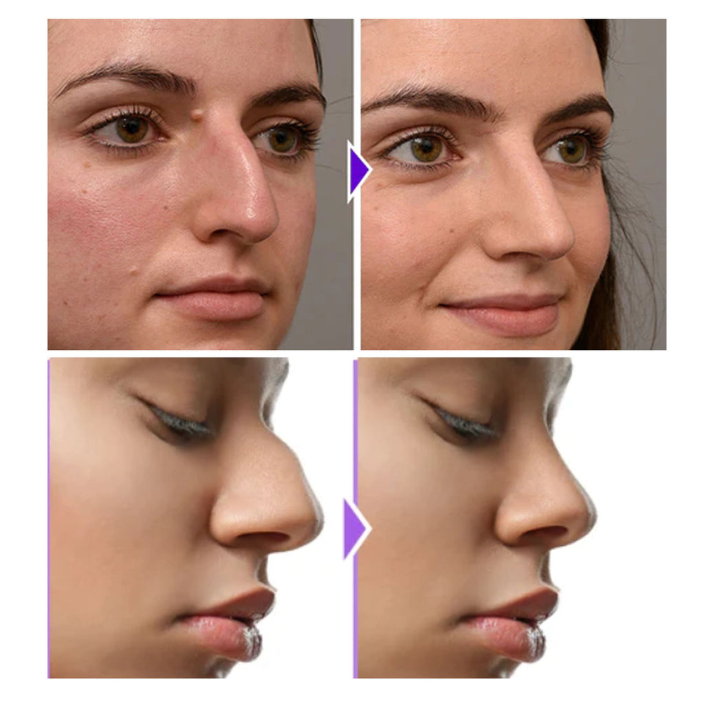 Beauty Nose Shaping Device